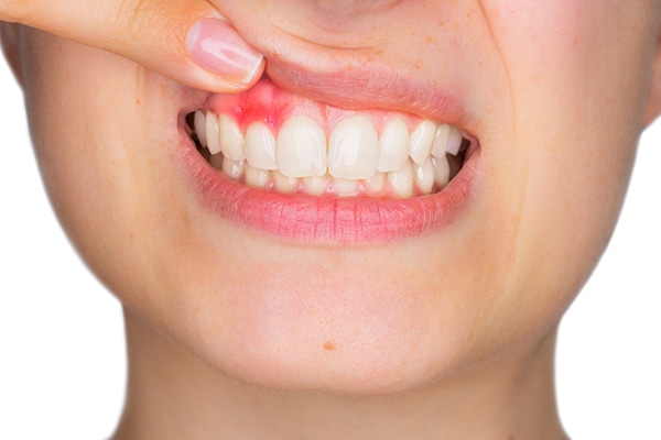 Enfermedades periodontales: Gingivitis