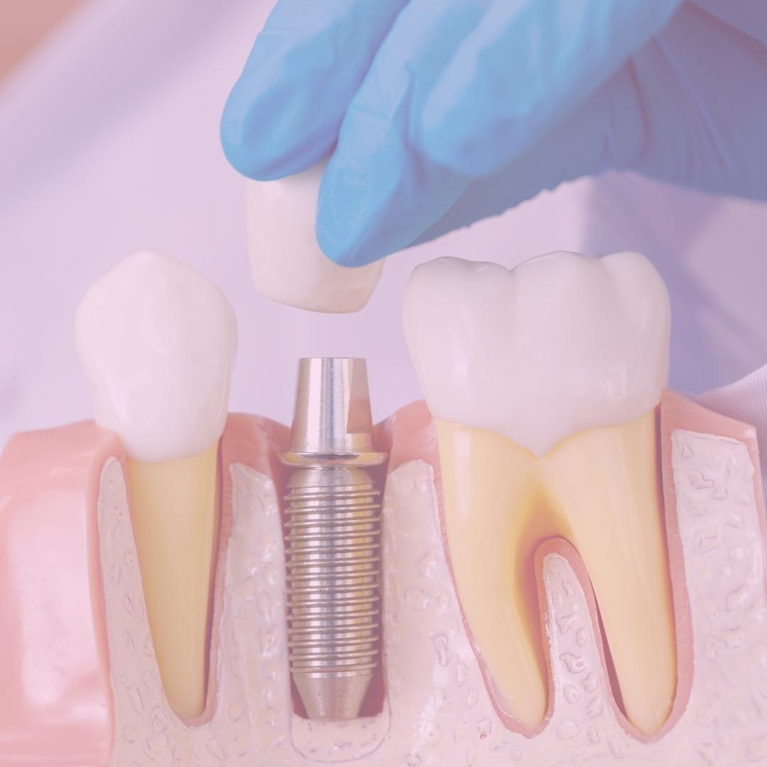 5 cosas que tienes que saber sobre implantes dentales