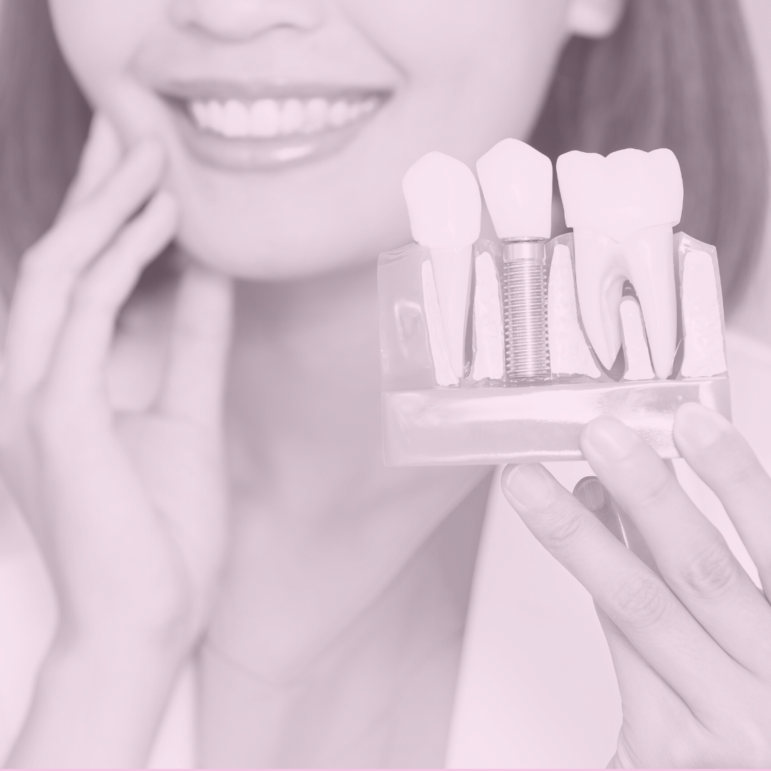 ¿Cómo saber si están sanos mis implantes dentales?