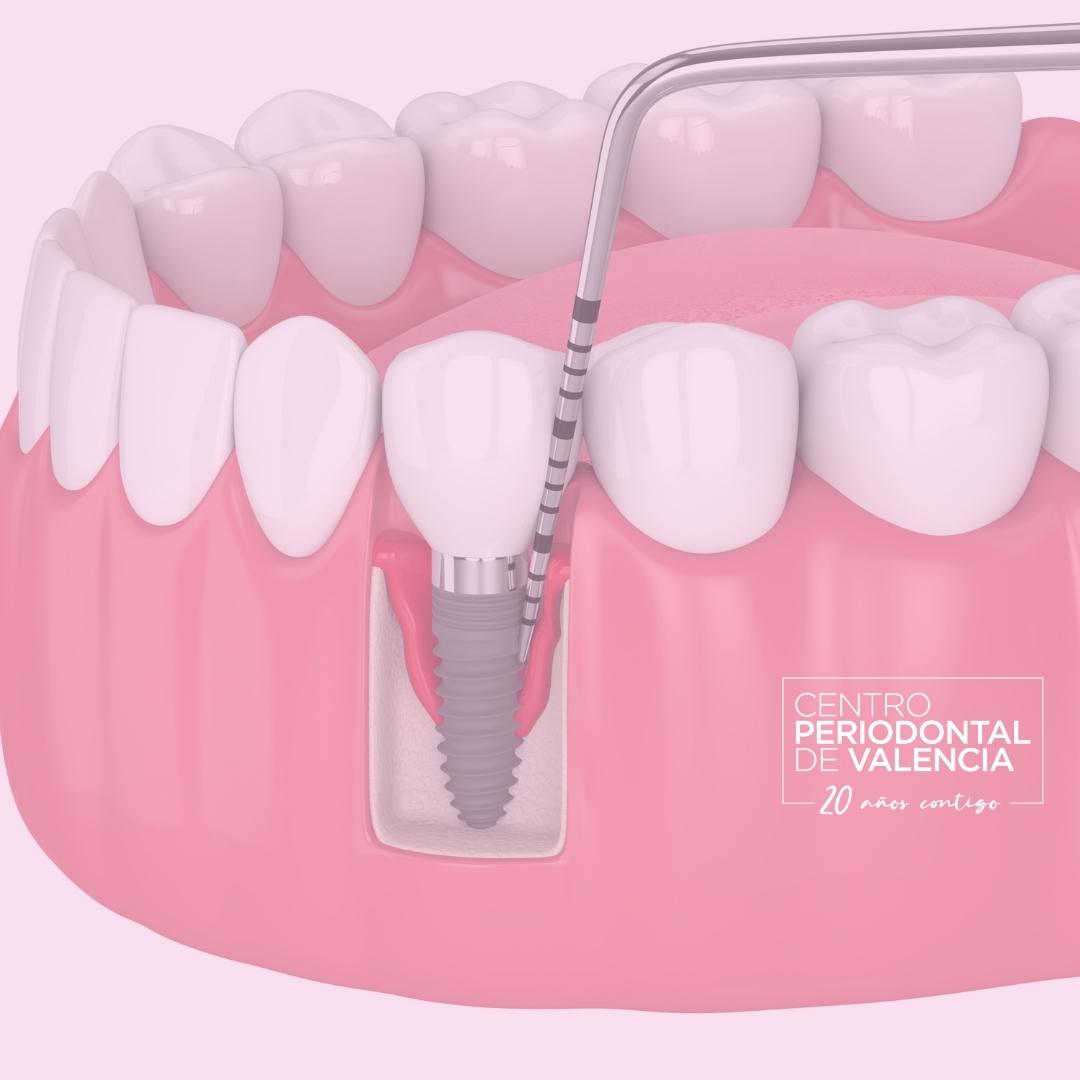 Implantes dentales y Periodontitis ¿Son compatibles?